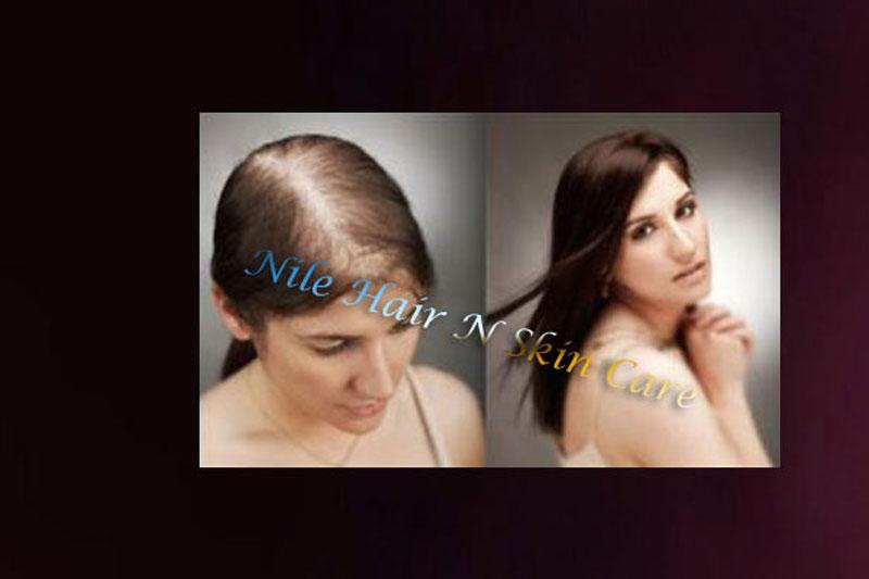 Hair Wigs in Bangalore | Hair Wigs Price in Bangalore - Hair Weaving Bangalore Hair Wigs in Bangalore | Hair Wigs Price in Bangalore - Hair Weaving Bangalore
